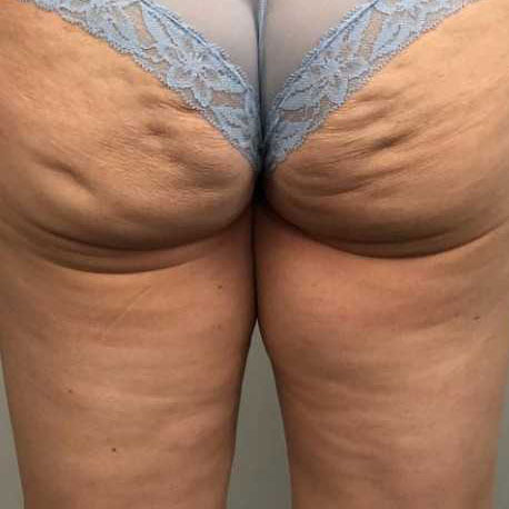 Cellulite 2024