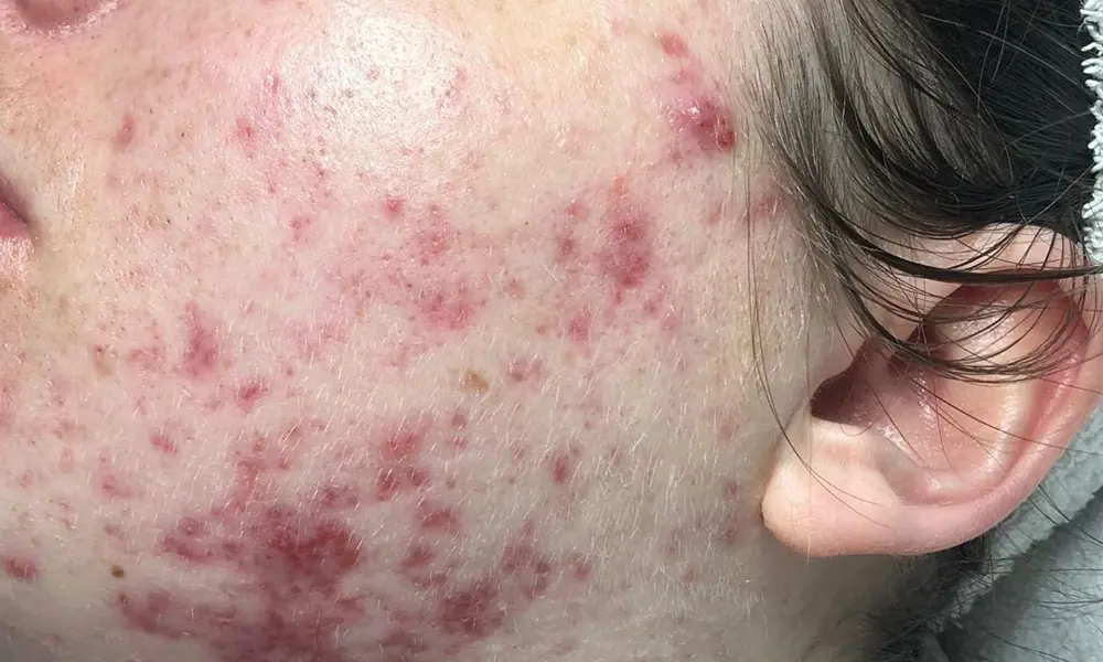 Before & After Treatment before image